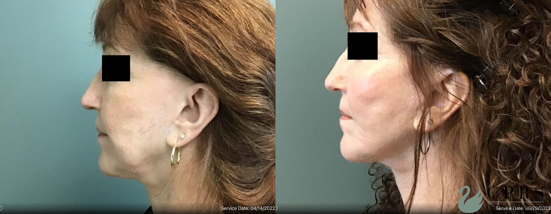 Before photo - Angle 2