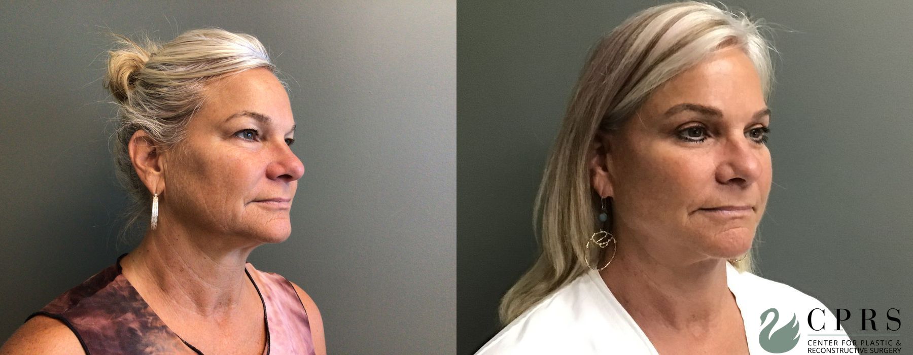 Before photo - Angle 3