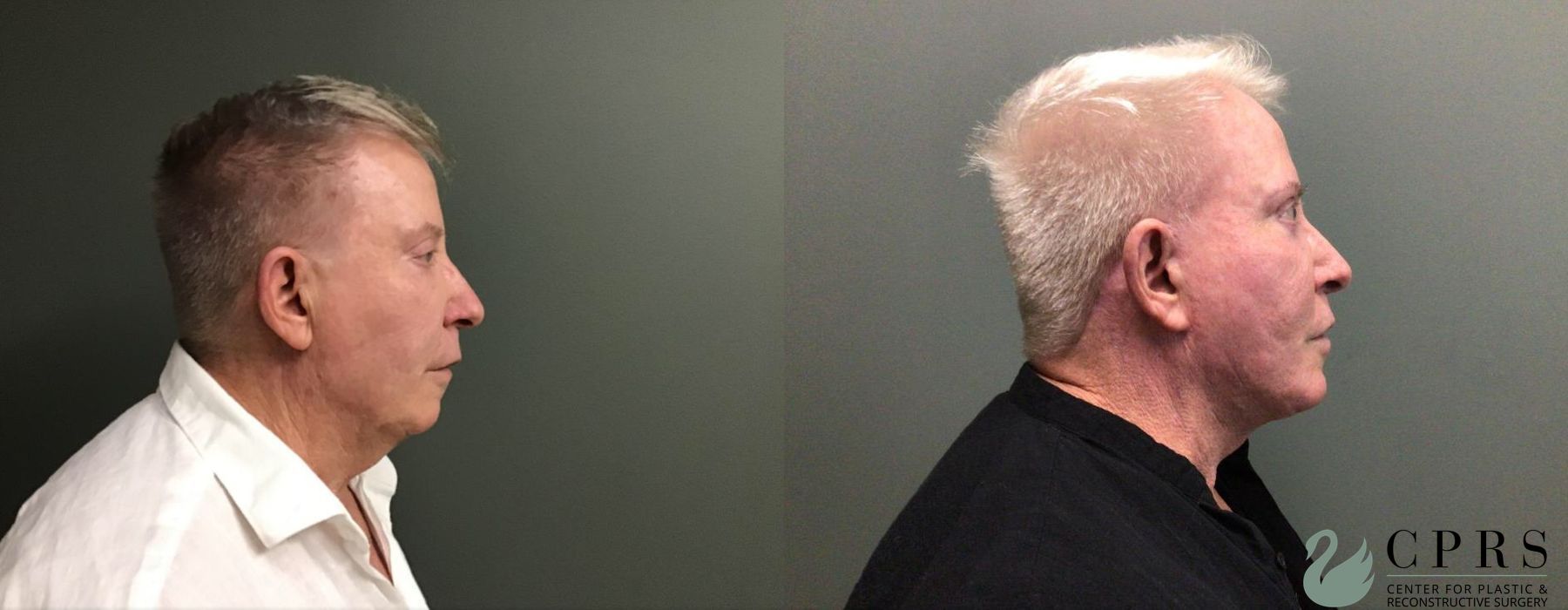 Before and after Facelift & Neck Lift case 19069 - Angle 2