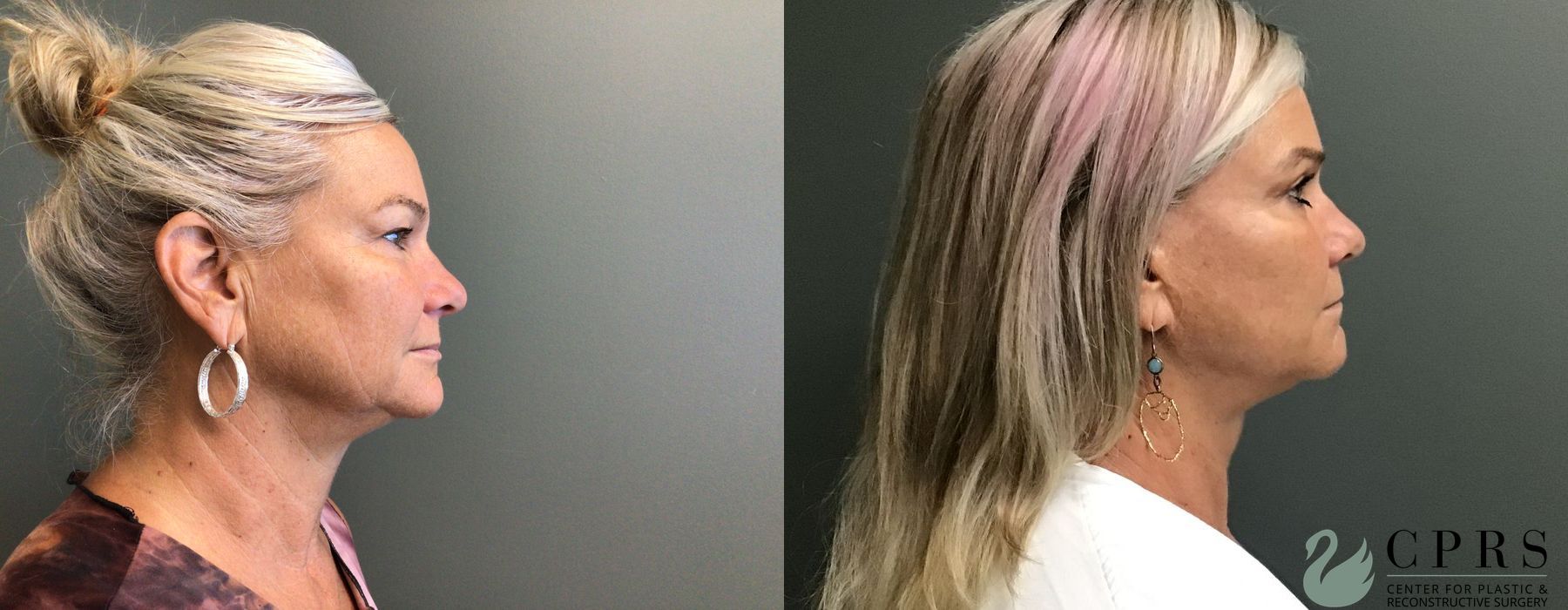 Before photo - Angle 2