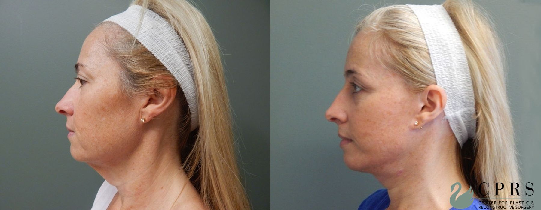 Before and after Facelift & Neck Lift case 19060 - Angle 2