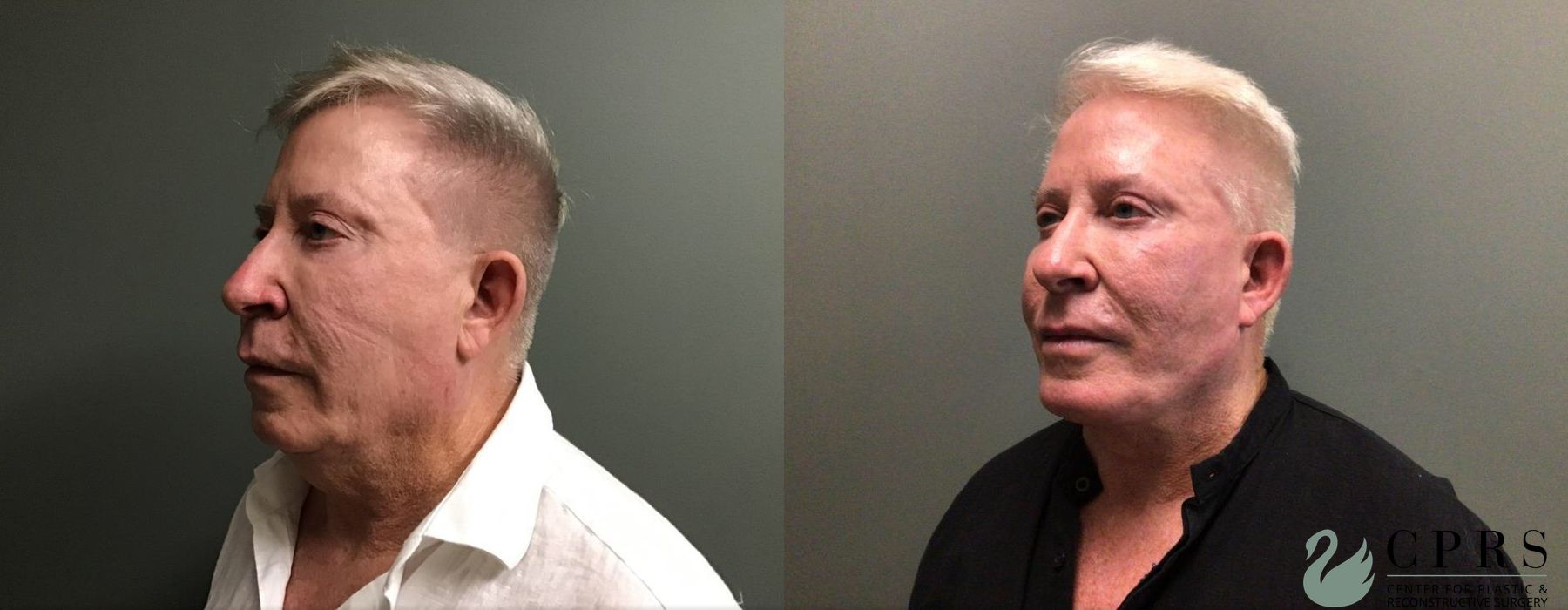 Before and after Facelift & Neck Lift case 19069 - Angle 5