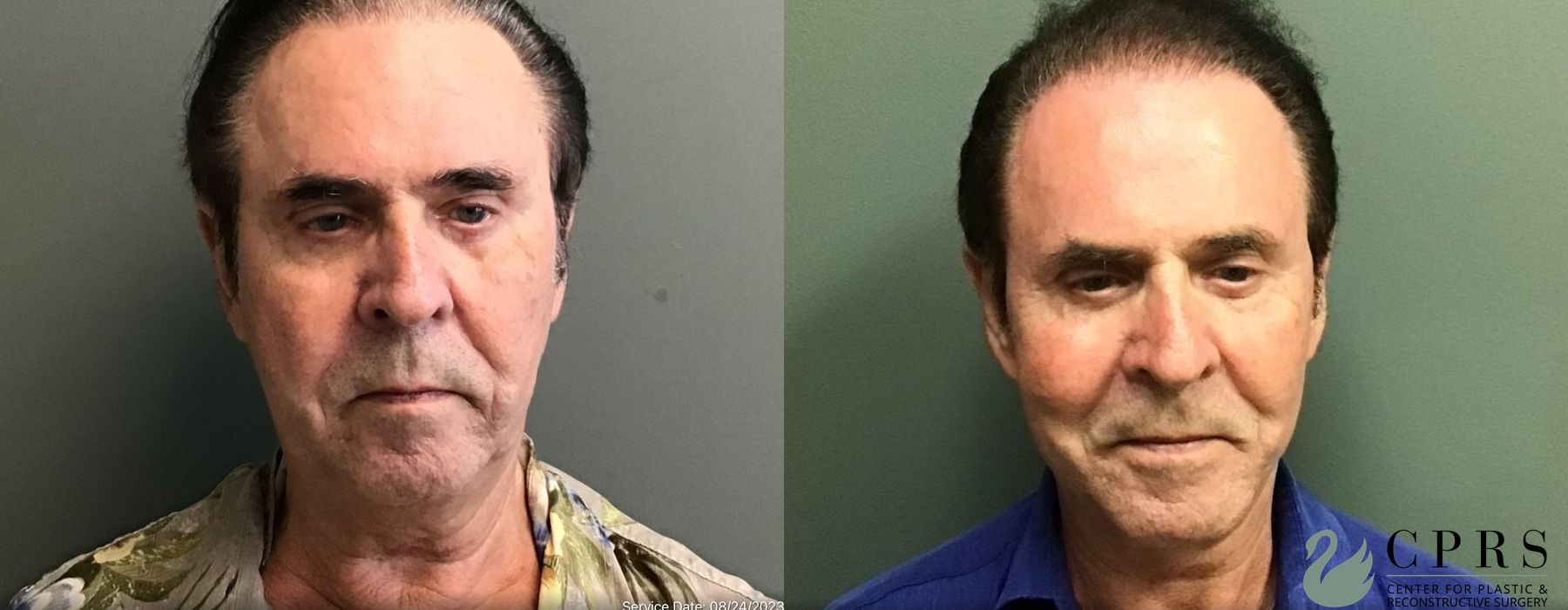Before and after Facelift & Neck Lift case 19177