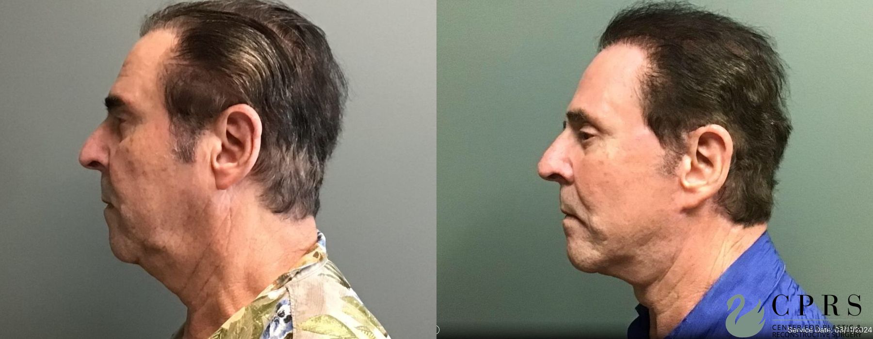 Before and after Facelift & Neck Lift case 19177 - Angle 3