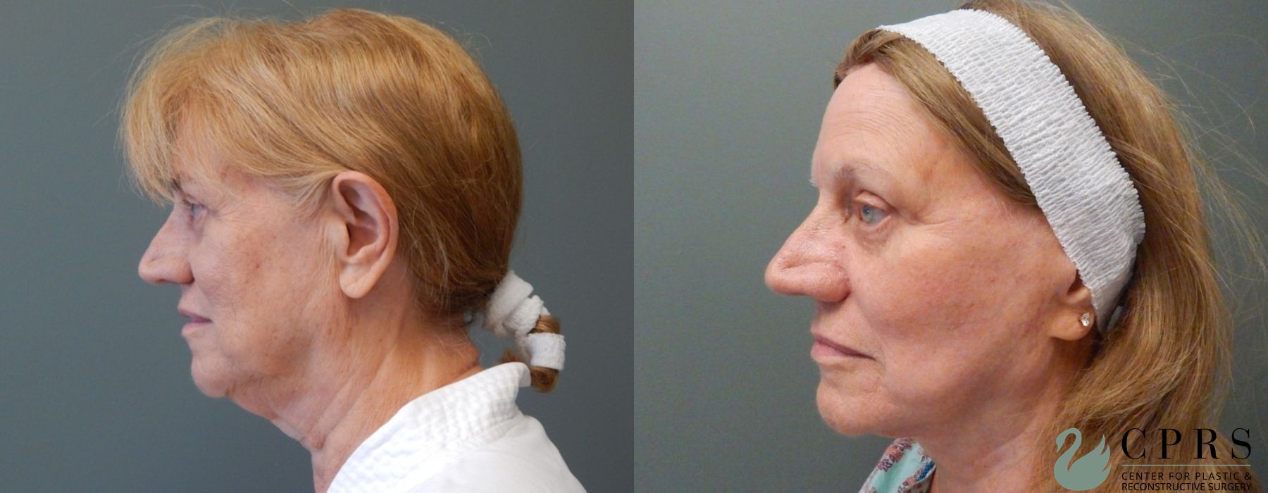 Before photo - Angle 3