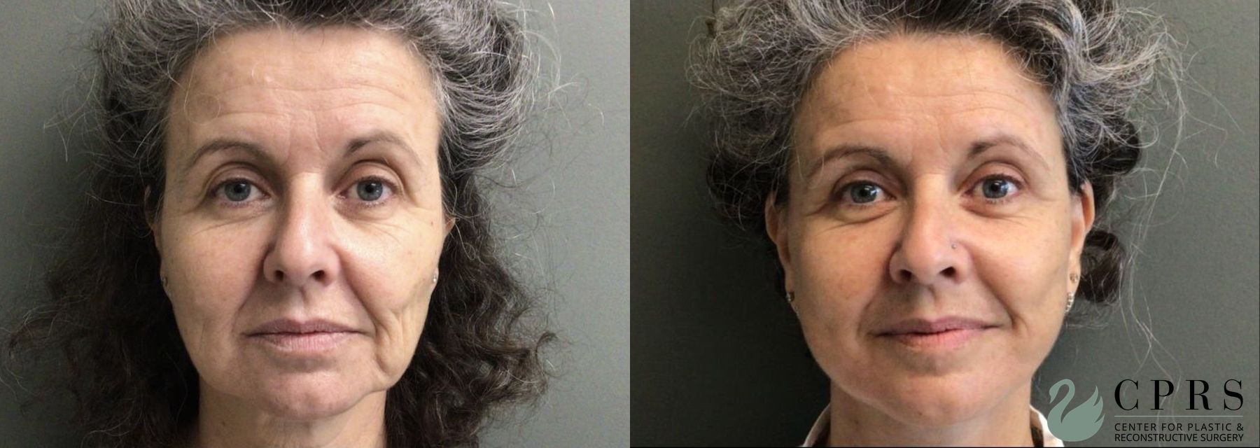 Before and after Facelift & Neck Lift case 19097