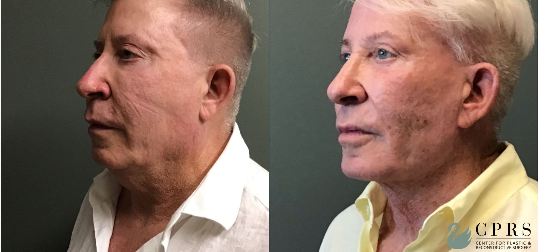 Before and after Chin Augmentation case 49393