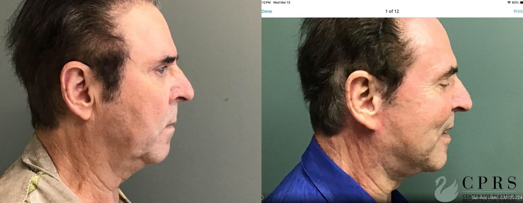 Before and after Facelift & Neck Lift case 19177 - Angle 2