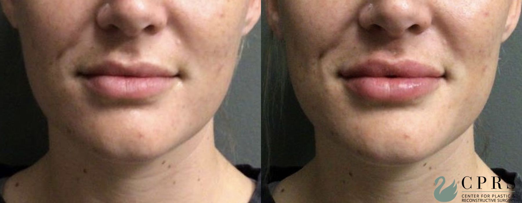 Before and after Fillers case 18970