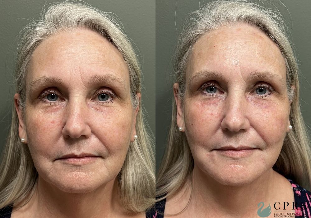 Before and after Fillers case 18953