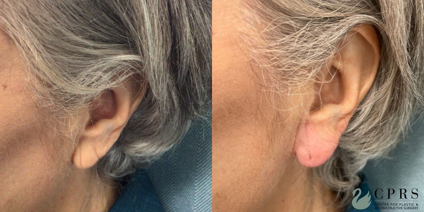 Before and after Fillers case 37389 - Angle 2