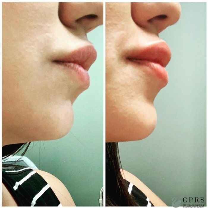 Before and after Fillers case 18988
