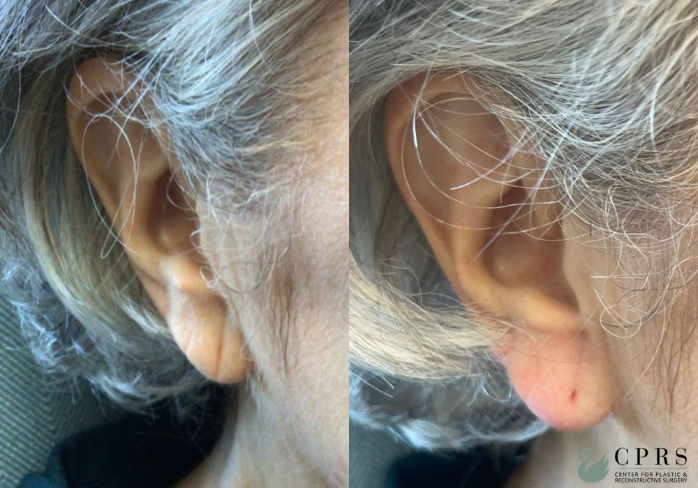 Before and after Fillers case 37389