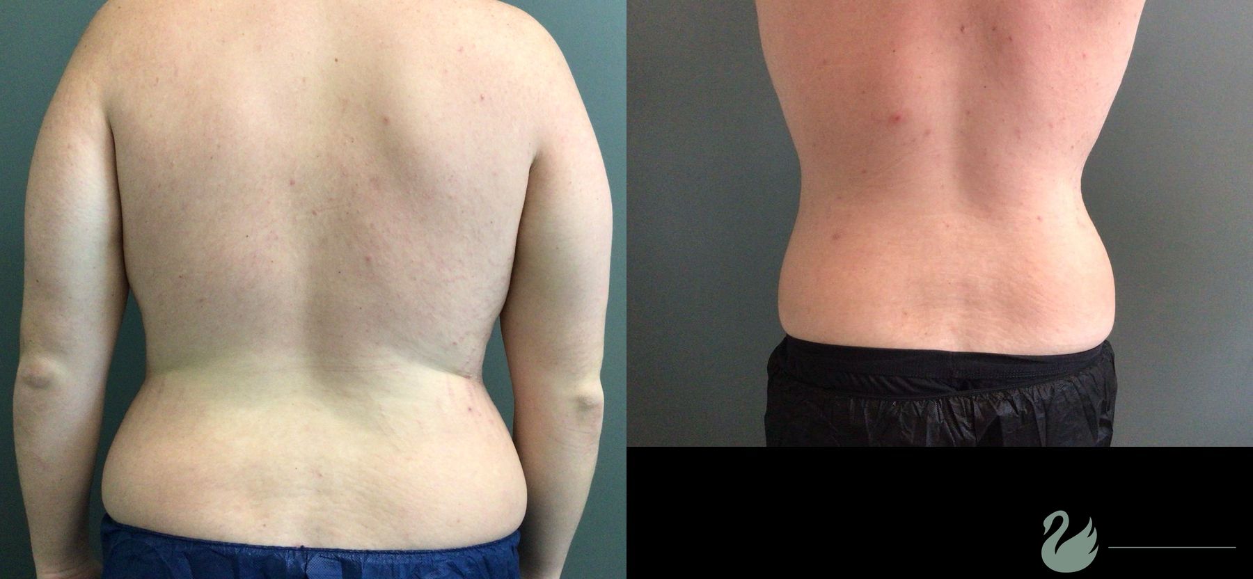 Before and after Gynecomastia case 43651 - Angle 4