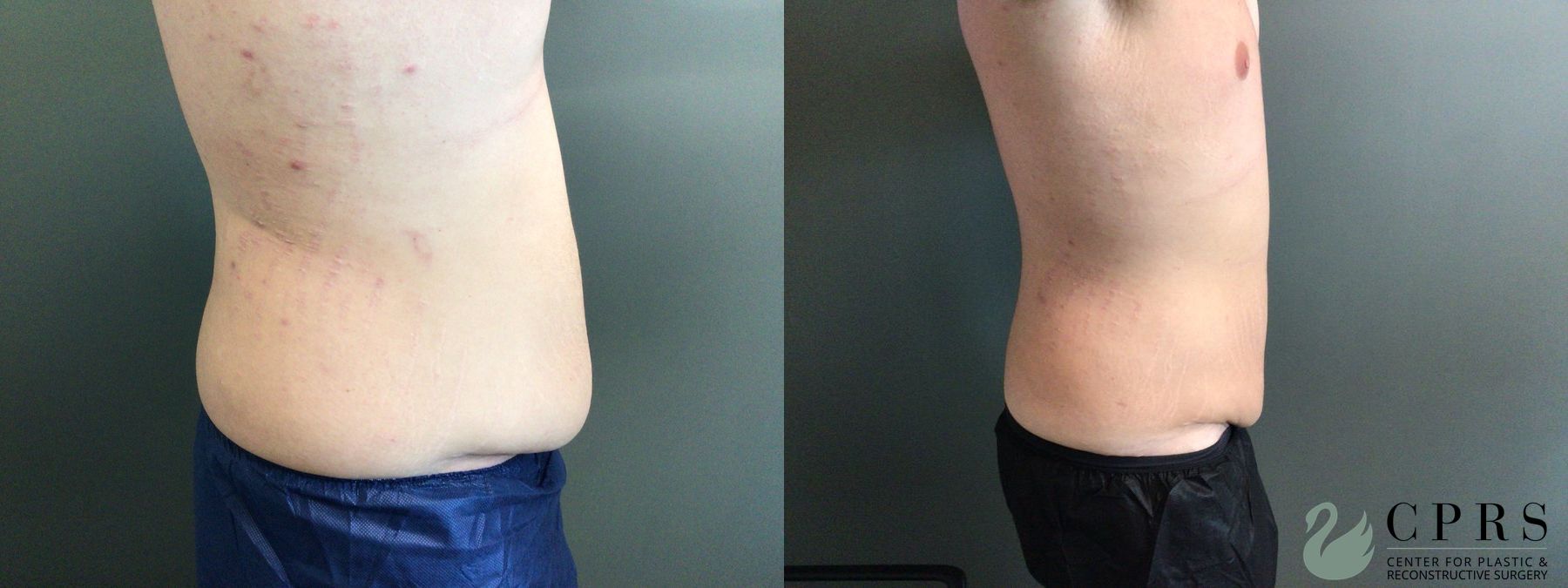 Before and after Gynecomastia case 43651 - Angle 2