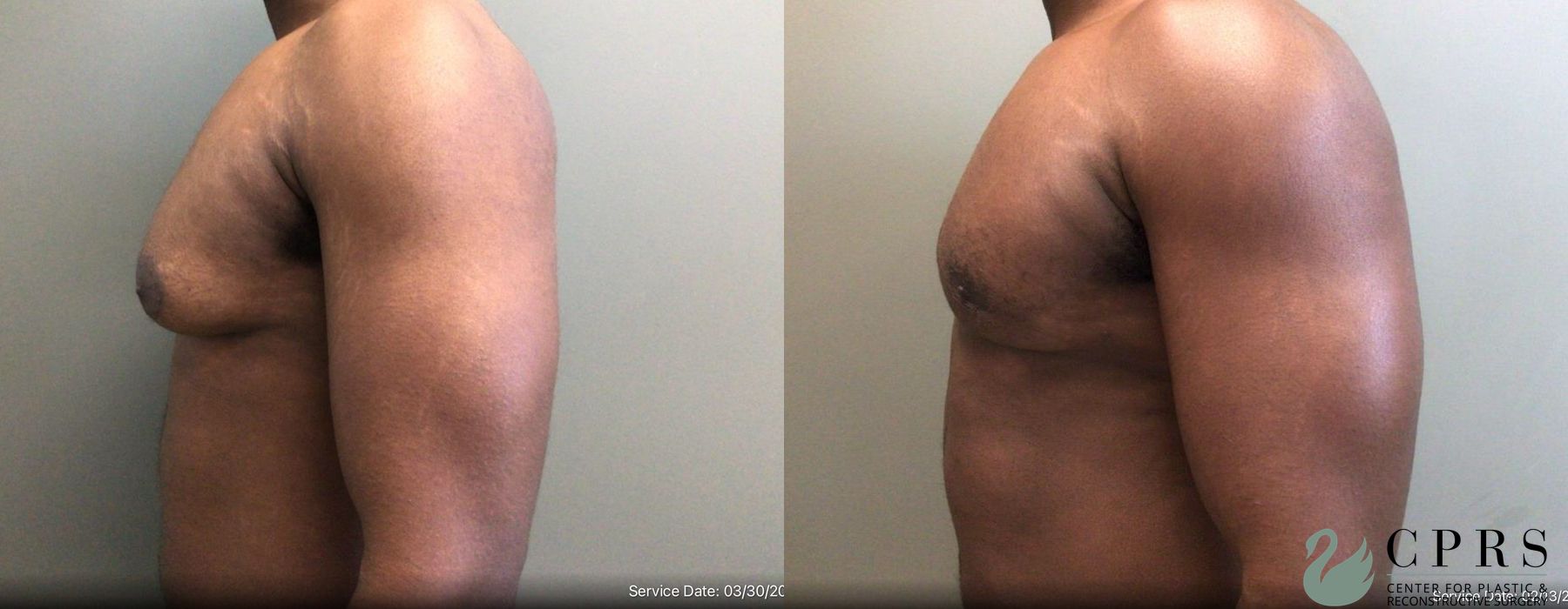 Gynecomastia - Thumbnail 3