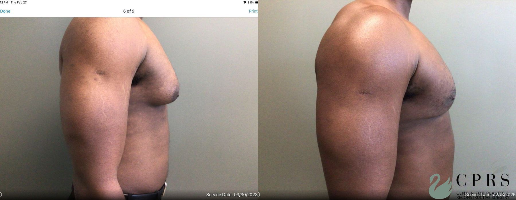 Gynecomastia - Thumbnail 2