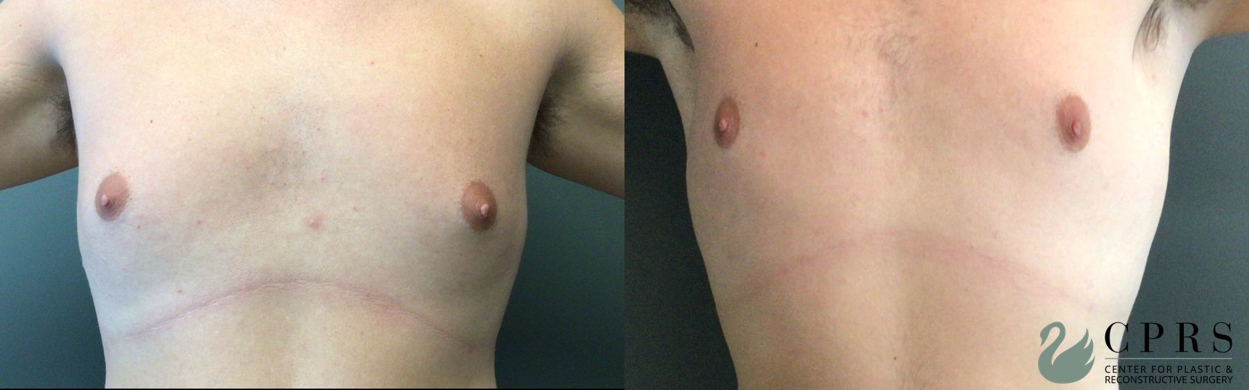 Before and after Gynecomastia case 43651