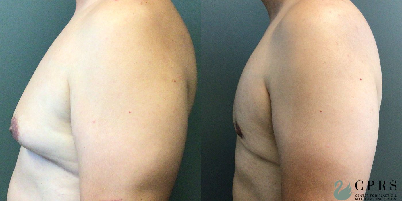 Gynecomastia - Thumbnail 2