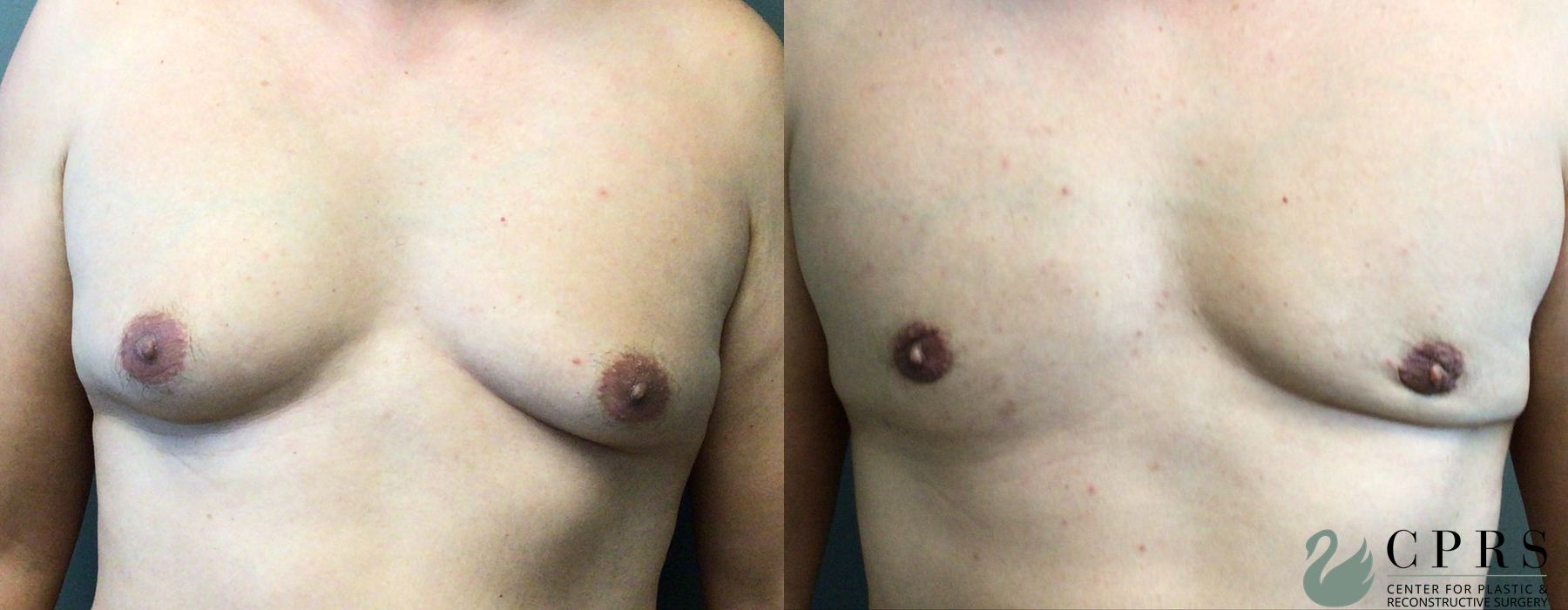Gynecomastia - Case 239690