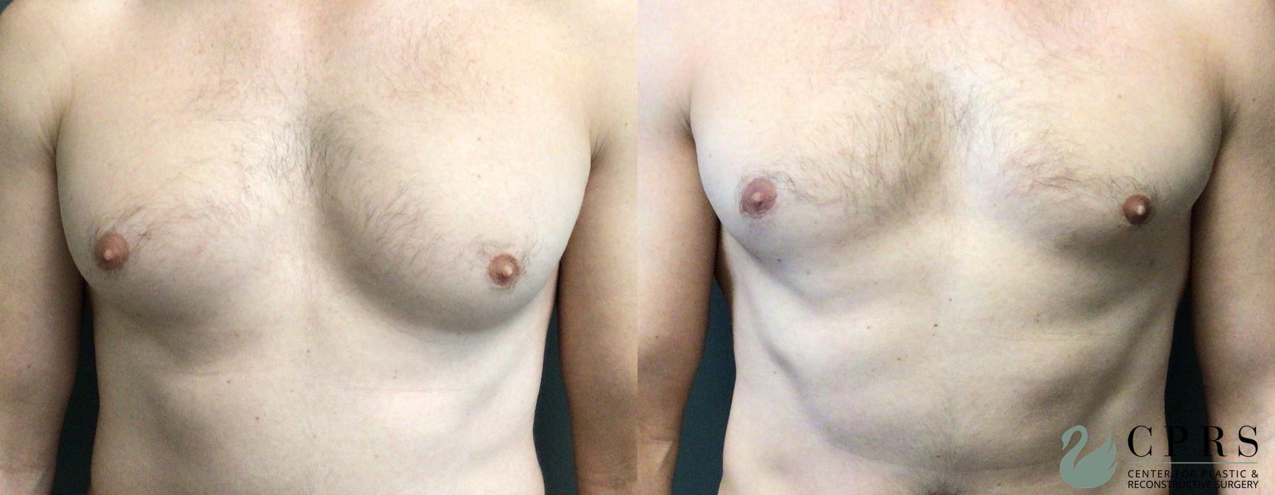 Before and after Gynecomastia case 33066