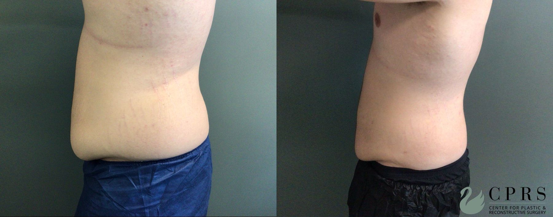 Before and after Gynecomastia case 43651 - Angle 3