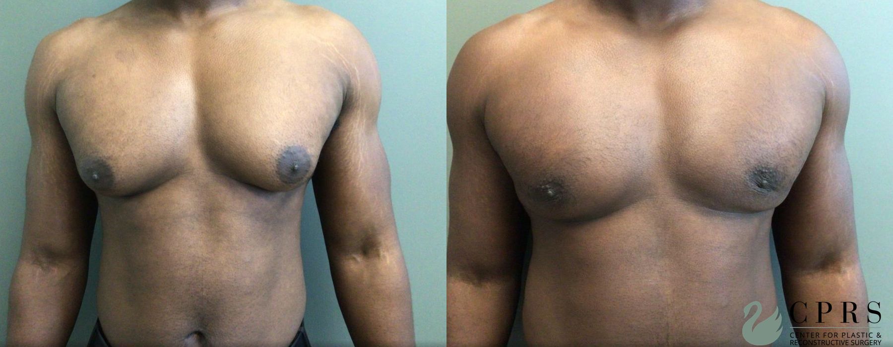 Gynecomastia - Case 239688
