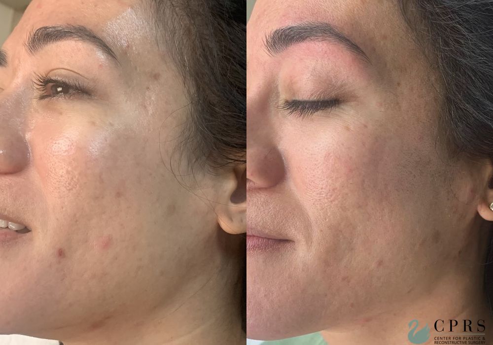 Before and after Hydrafacial case 19067