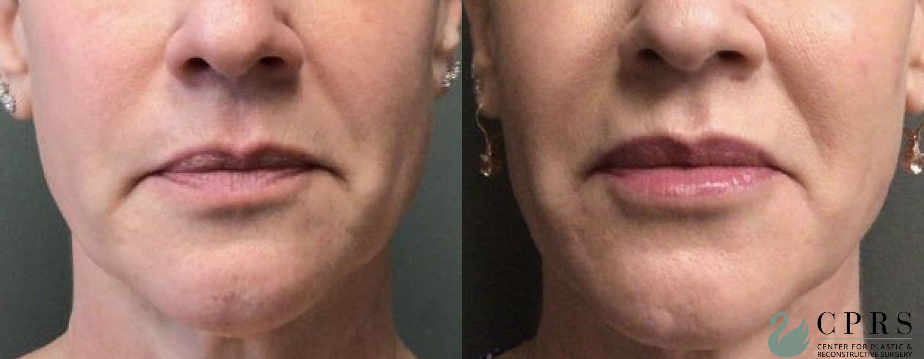 Before and after Injectables case 18963