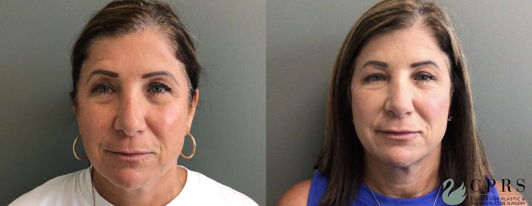 Before and after Injectables case 18986