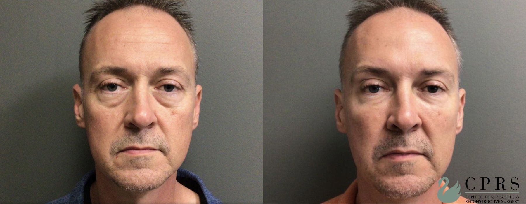 Before and after Injectables case 18979