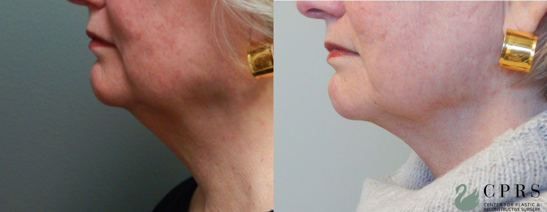 Before photo - Angle 2