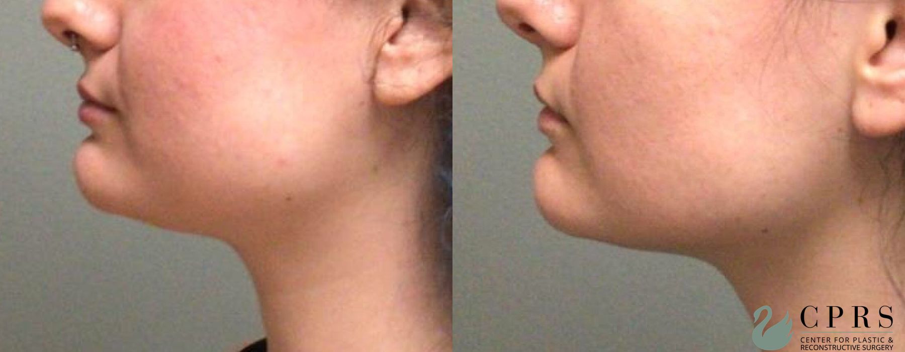 Before photo - Angle 2