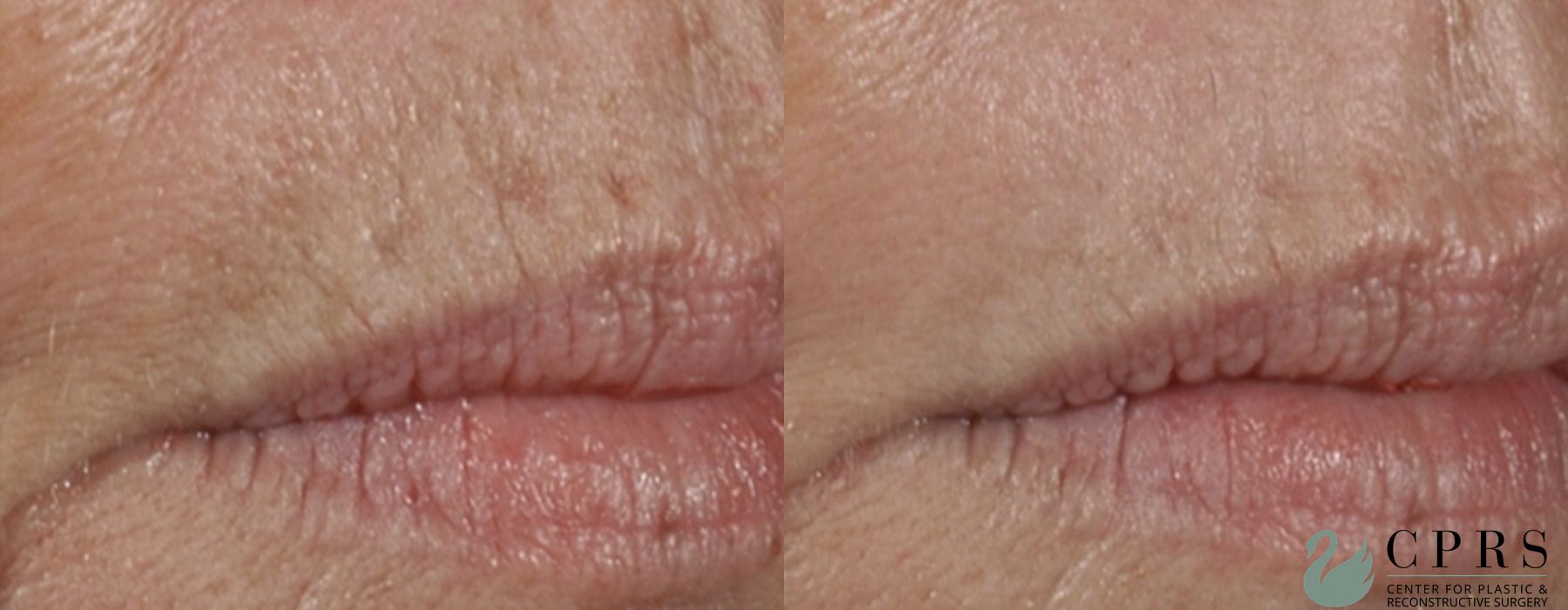 Before and after Laser case 19050