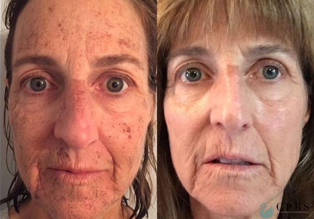 Before and after Laser case 19043