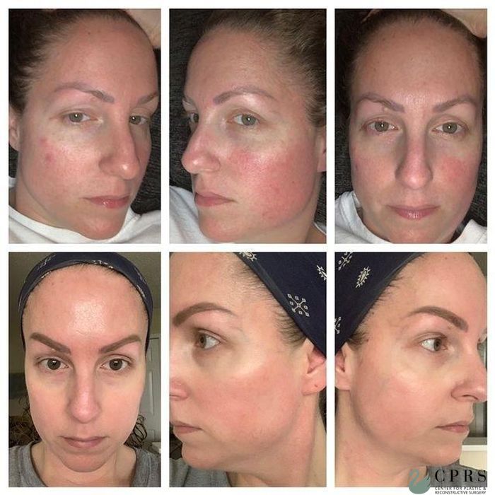 Before and after Laser case 19042
