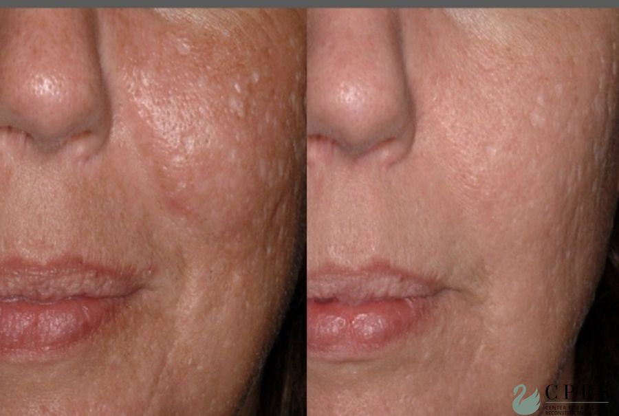 Before and after Laser case 19048
