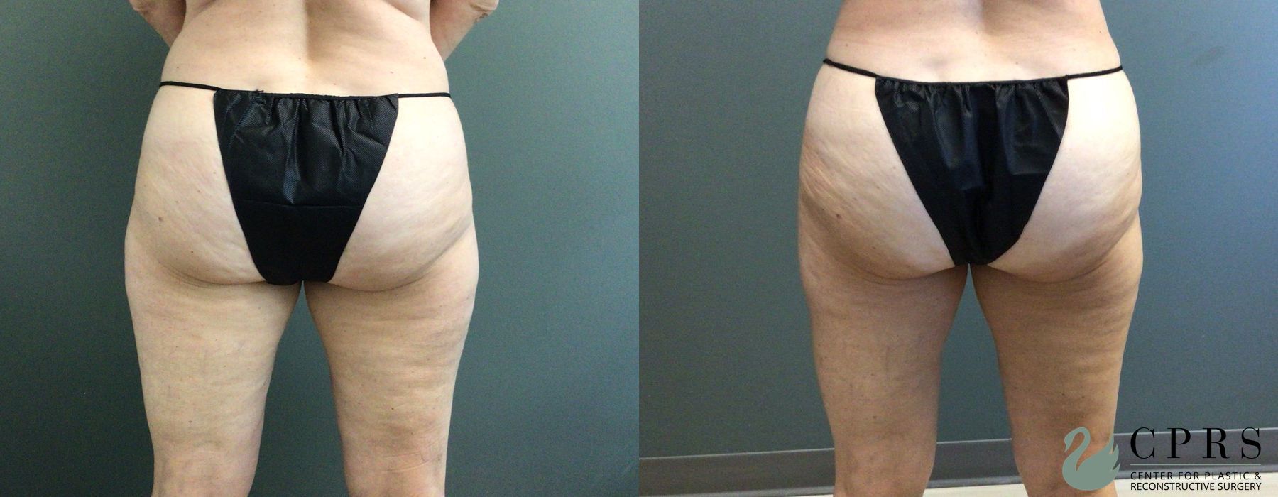 Before and after Liposuction case 33065 - Angle 3
