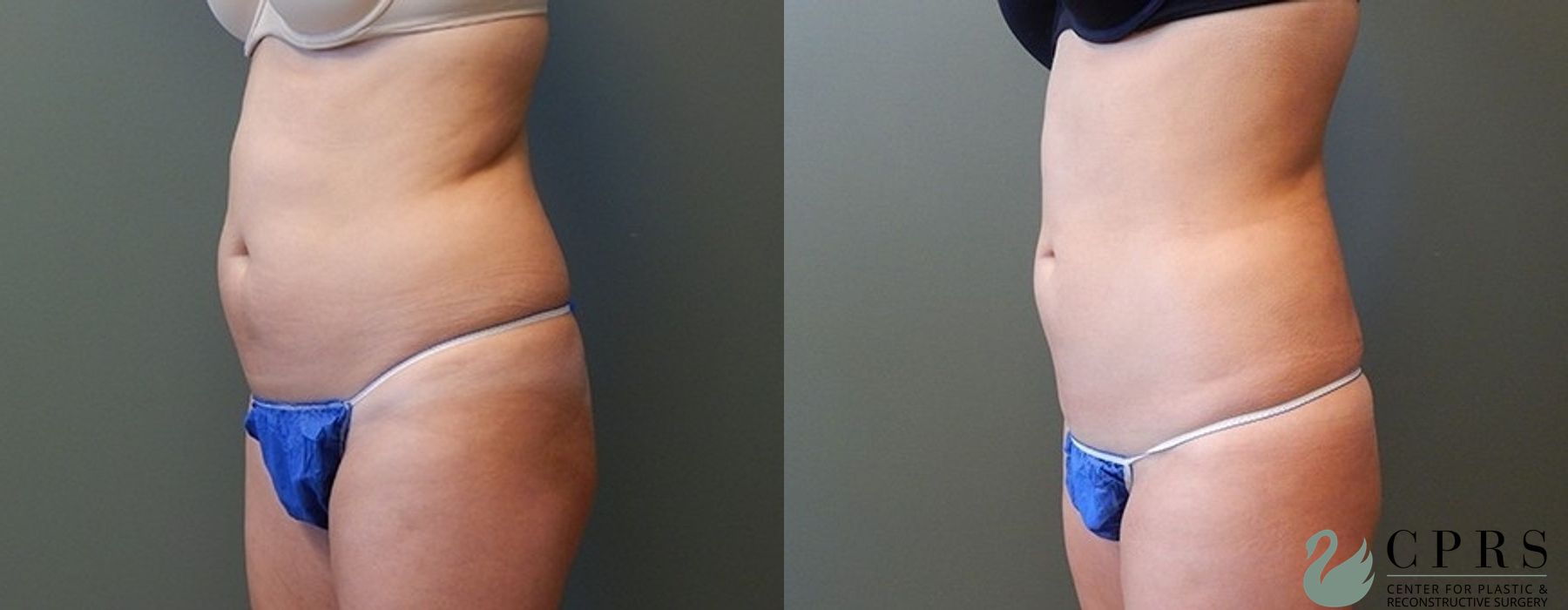 Liposuction - Thumbnail 2