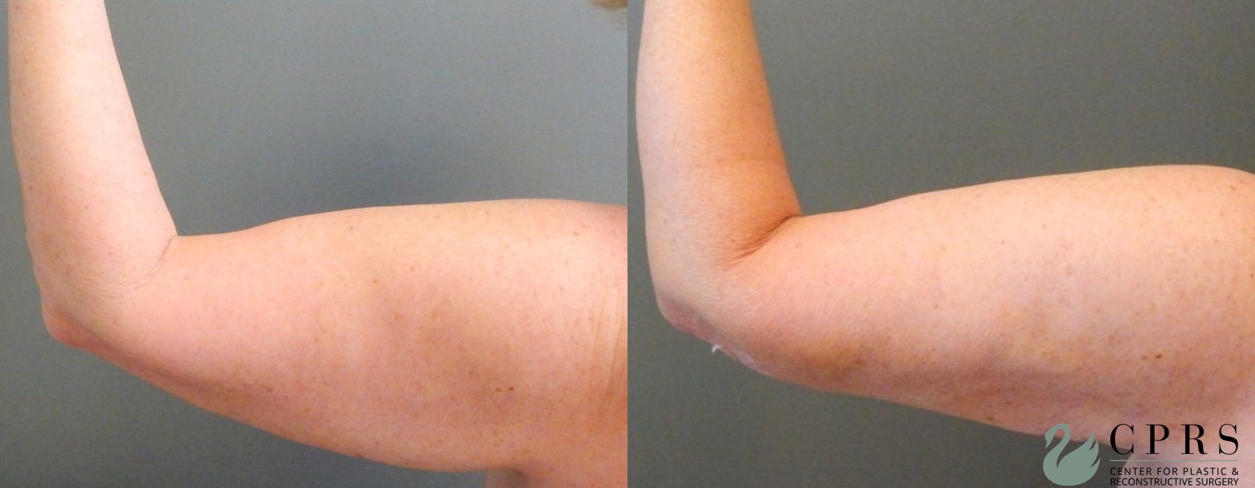 Before and after Liposuction case 19058 - Angle 2