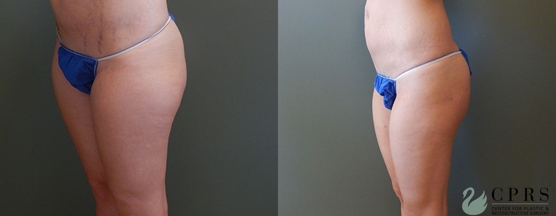 Before and after Liposuction case 19062 - Angle 2