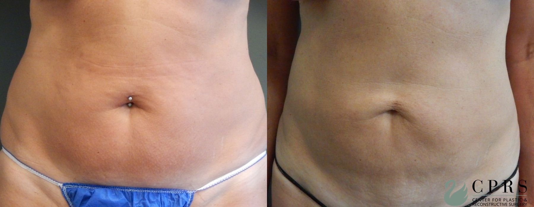 Before and after Liposuction case 18984