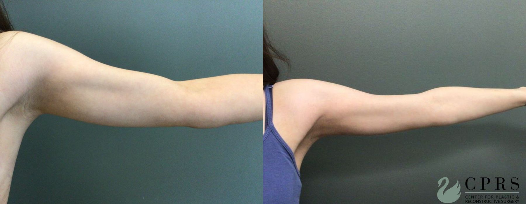 Before and after Liposuction case 19110