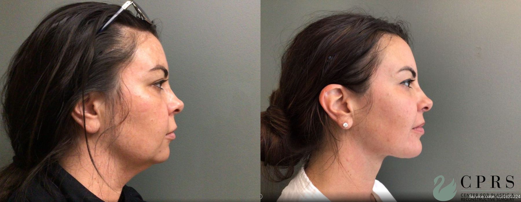Before and after Liposuction case 19159 - Angle 2