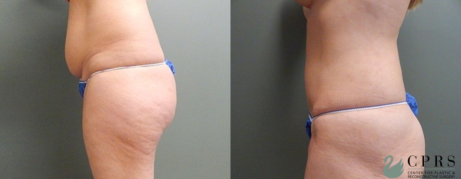 Before and after Liposuction case 18930 - Angle 3