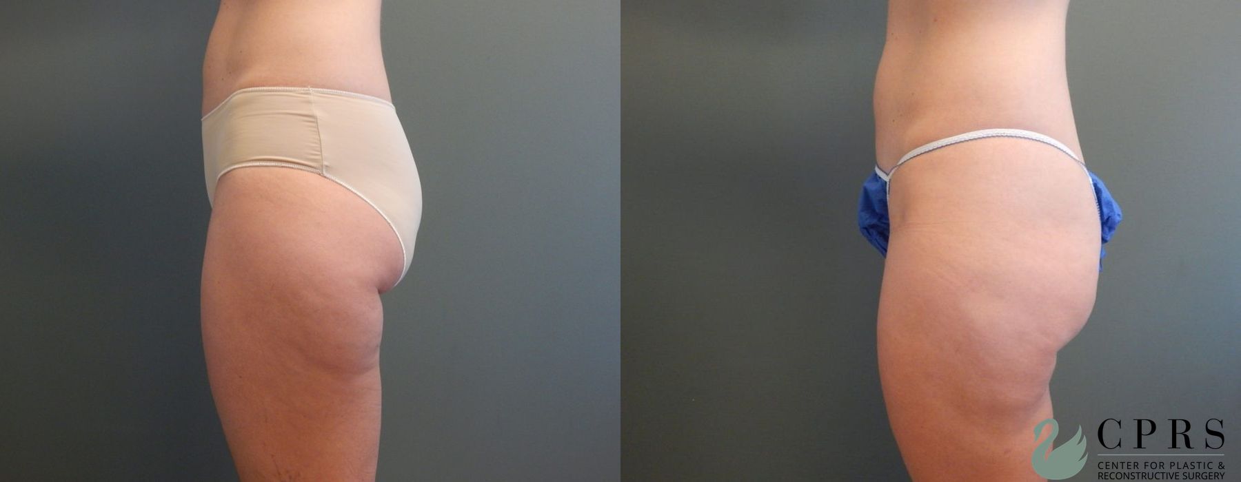 Liposuction - Thumbnail 2