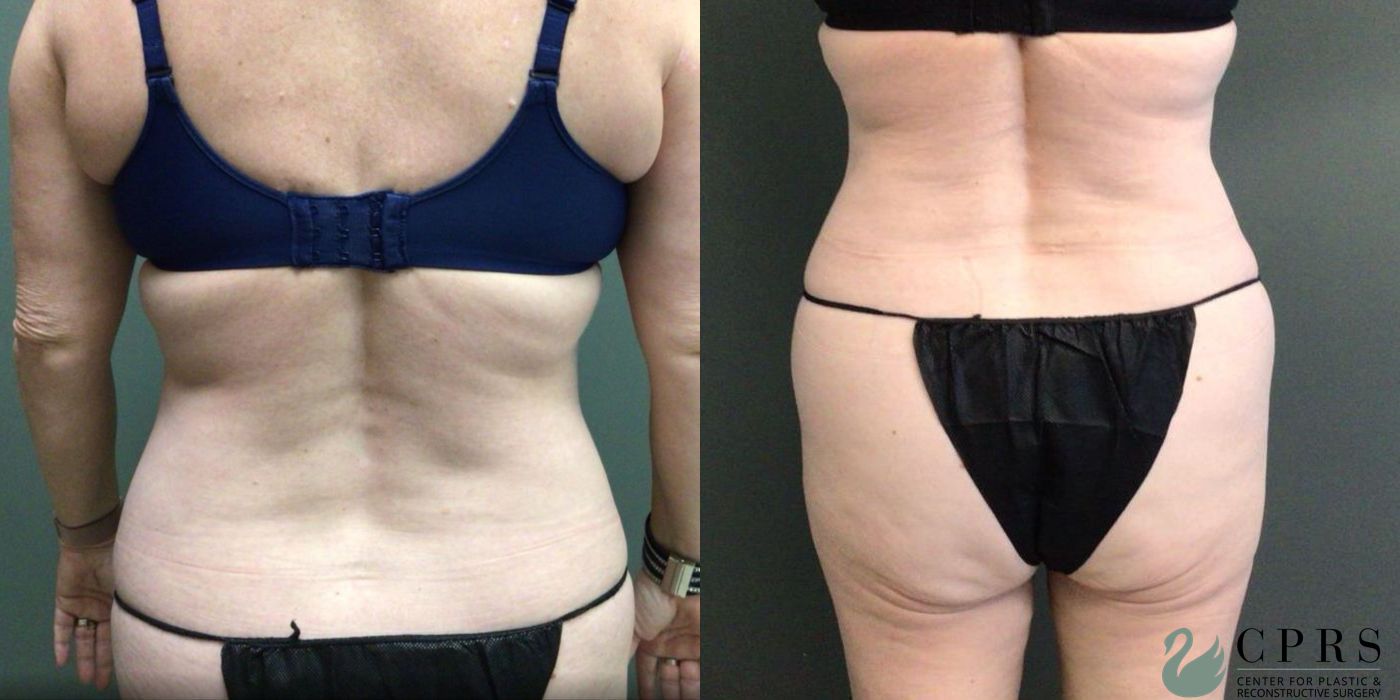 Before and after Liposuction case 19174 - Angle 2
