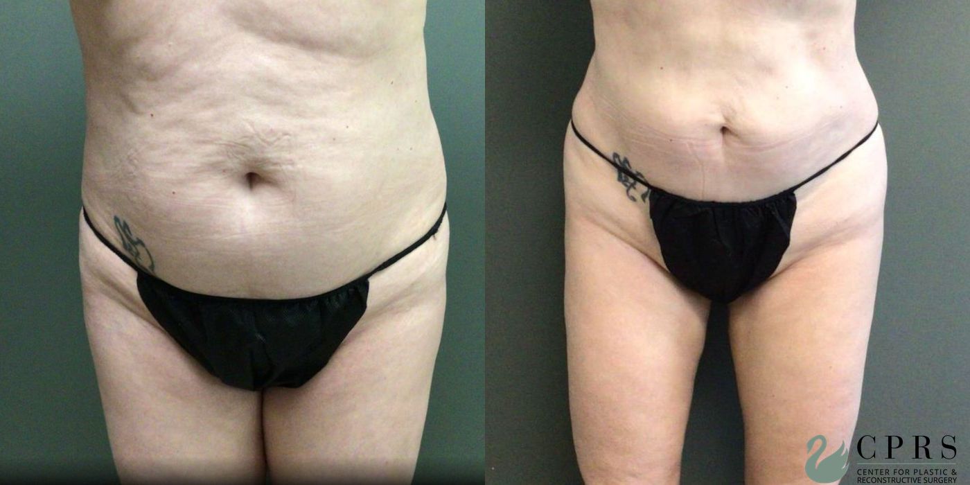 Before and after Liposuction case 19174
