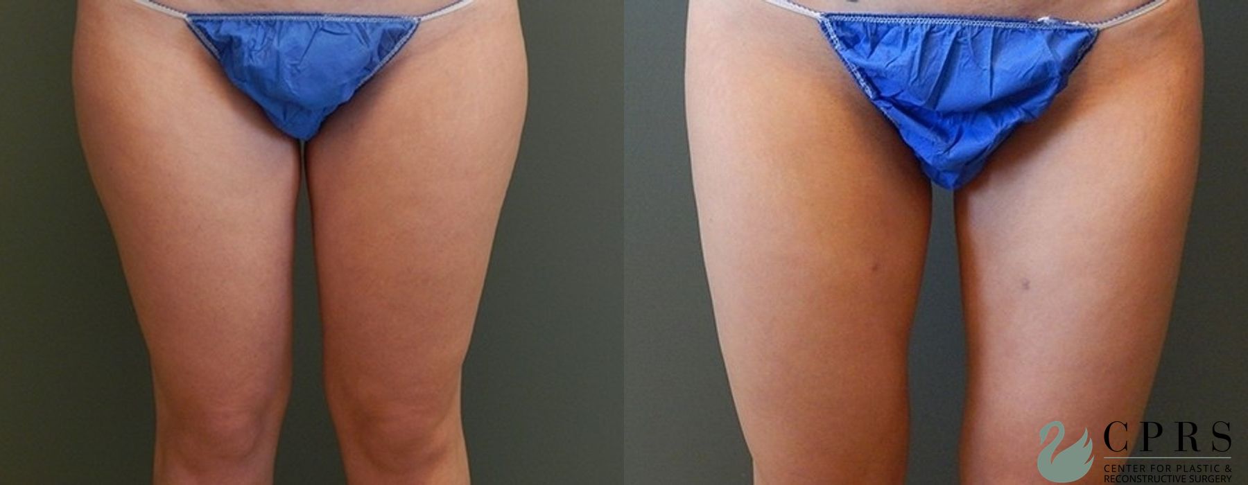 Before and after Liposuction case 19062