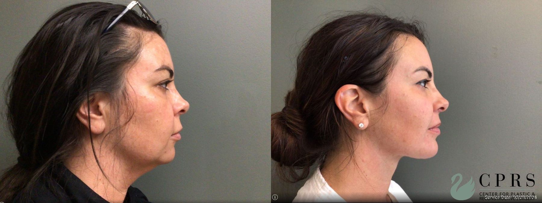 Before and after Liposuction case 19159 - Angle 2